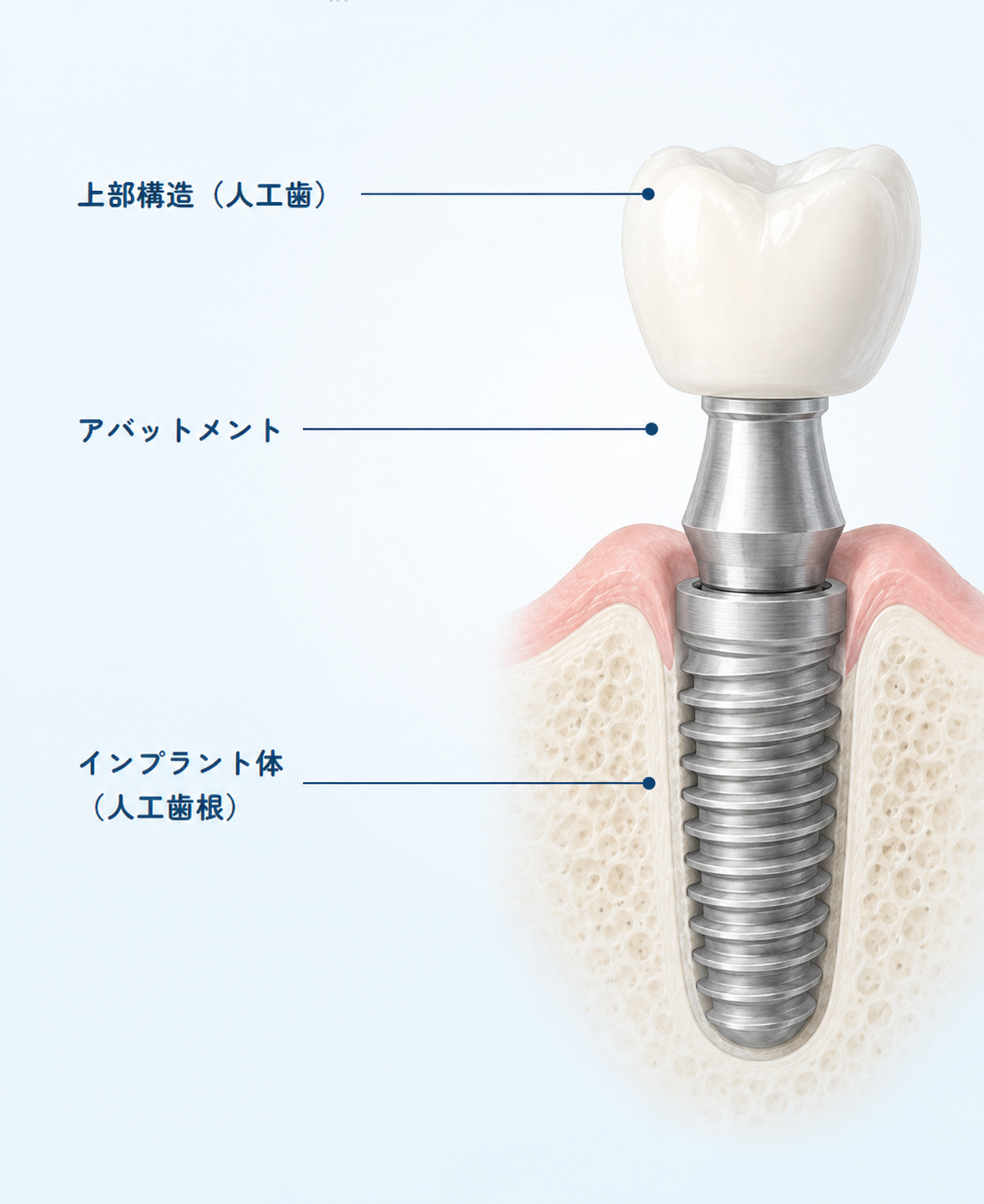 上部構造、アバットメント、インプラント体から構成されるインプラントの構造